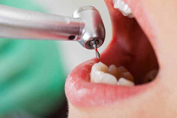 Best Emergency Tooth Extraction in Syosset, NY